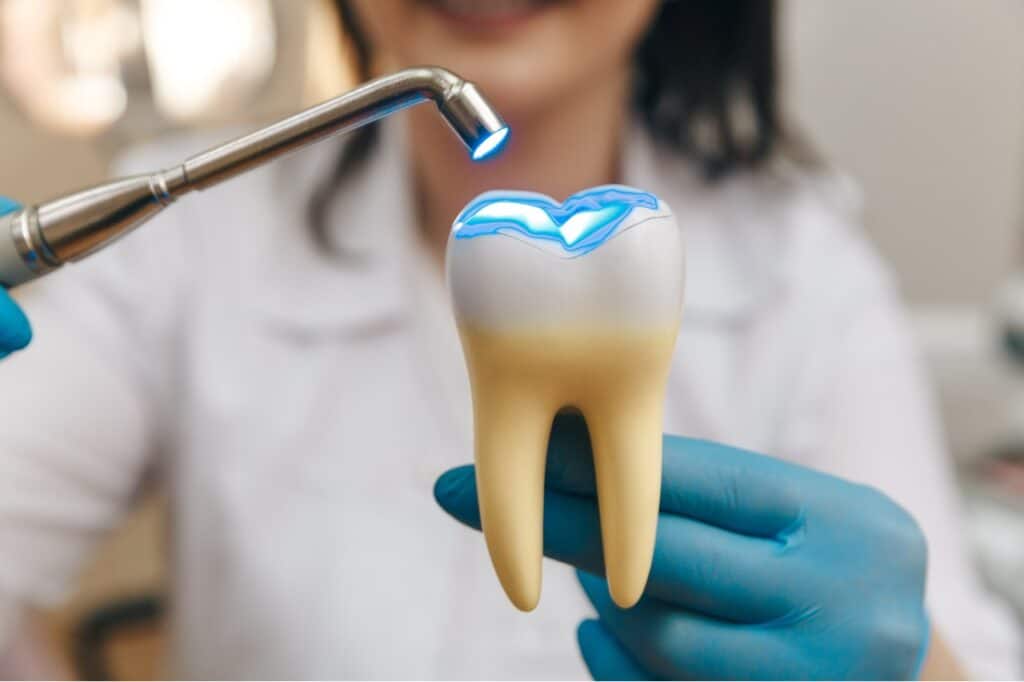 tooth fillings for tooth repair by Creekside Dental