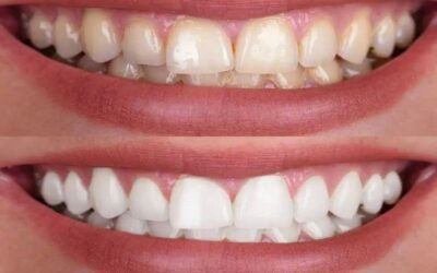 A Guide to Teeth Whitening