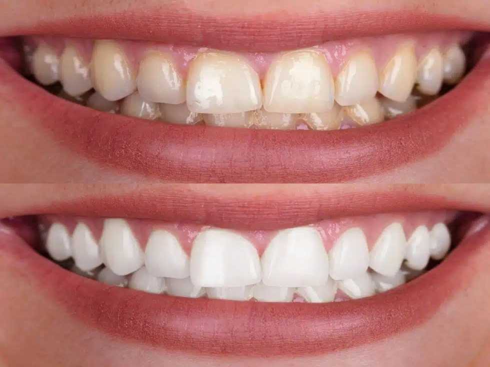 before and after teeth whitening Creekside Dental