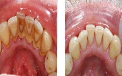 Plaque and Tartar (Calculus) Buildup – What is it? How can I Prevent it?