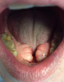 tori underneath the tongue Creekside Dental