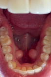 torus underneath the tongue Creekside Dental