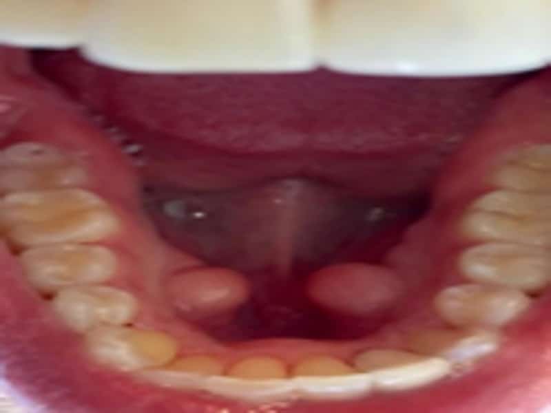 torus or tori underneath the tongue Creekside Dental