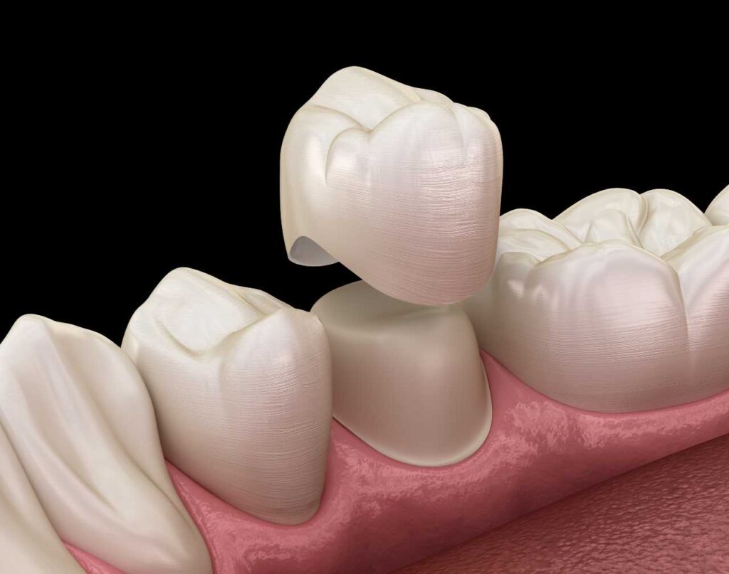 dental crown Creekside Dental