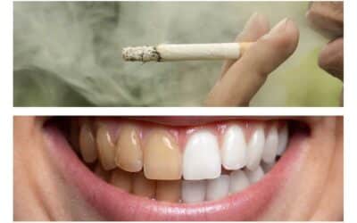 The Connection Between Smoking and Teeth Discoloration