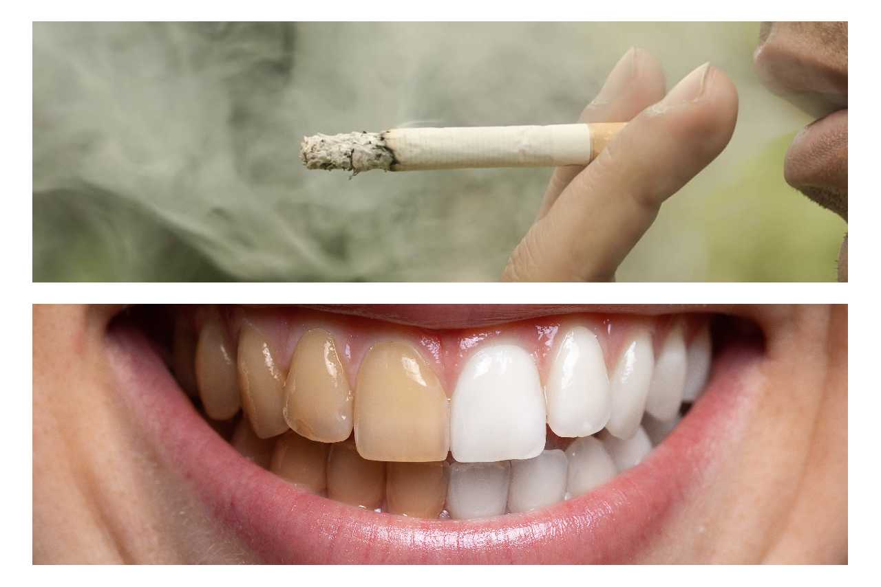 the connection between smoking and teeth discoloration Creekside Dental