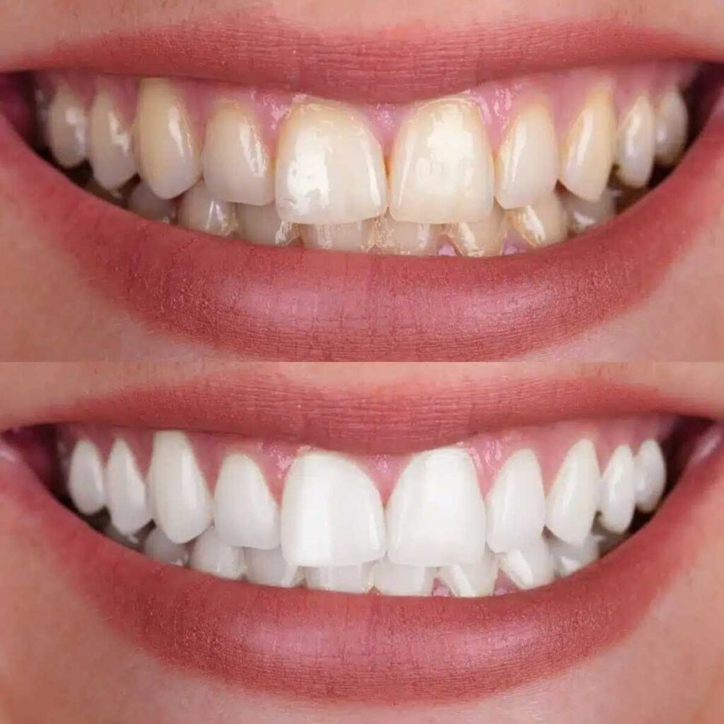 professional teeth whitening pros and cons Creekside Dental
