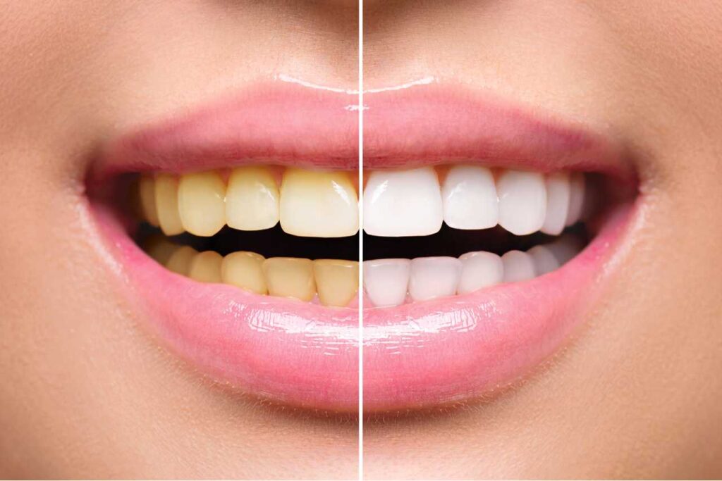 before and after zoom teeth whitening service Creekside Dental
