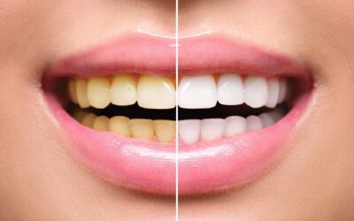 Teeth Whitening and Overall Dental Care: How to Integrate Whitening into Your Oral Hygiene Routine