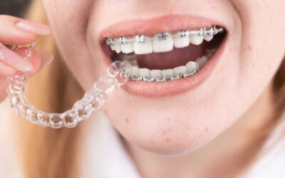 The Cost of Orthodontic Treatment: How to Make Braces More Affordable