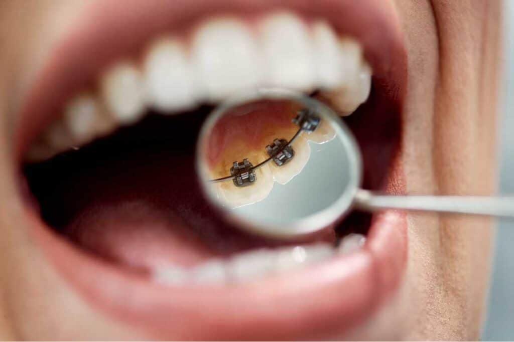 lingual braces Creekside Dental