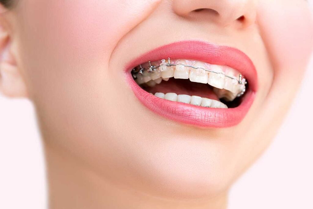 self-ligating braces Creekside Dental