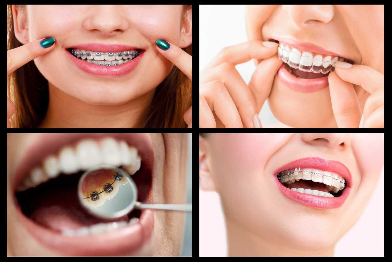 types of braces Creekside Dental