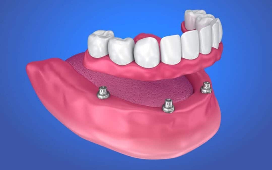 Is All-on-4 Right for You? Key Factors to Consider Before Choosing Full Arch Implants