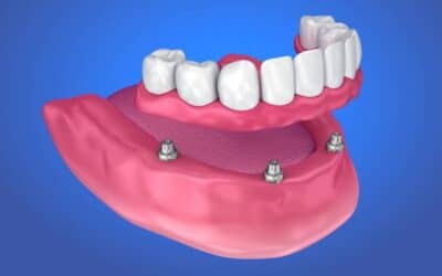 Is All-on-4 Right for You? Key Factors to Consider Before Choosing Full Arch Implants