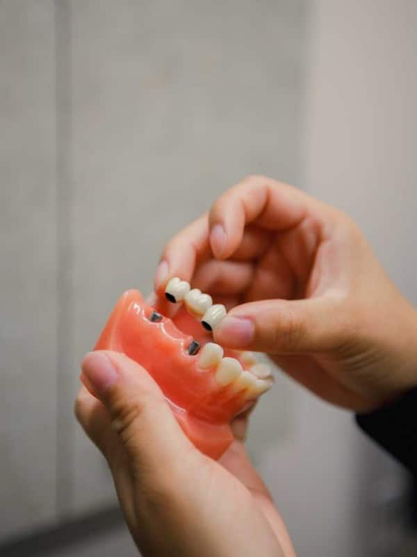 dental crown repair by Creekside Dental Kennewick