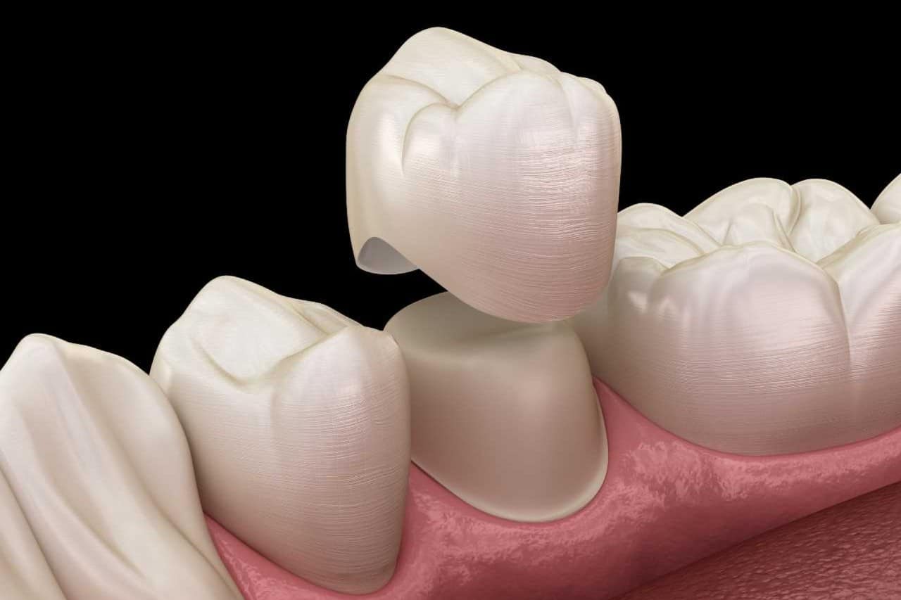 caring for your dental crowns