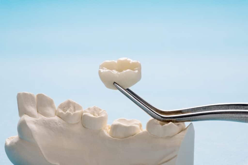 types of dental crowns
