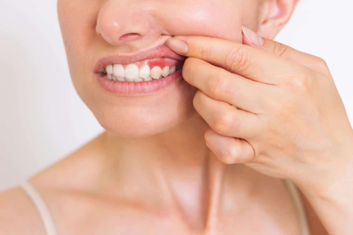 How to Reduce Gum Irritation During Invisalign Treatment