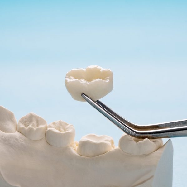 Closeup / Prosthodontics or Prosthetic / Single teeth crown and bridge equipment model express fix restoration.